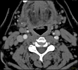 Small Neck Nodes - CTisus CT Scan