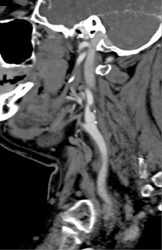 Plaque in Internal Carotid Artery - CTisus CT Scan