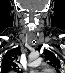 Thyroid Mass Encases the Carotid Artery - CTisus CT Scan