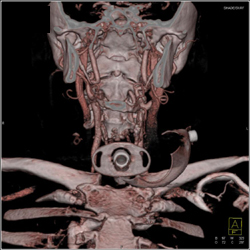 Tracheostomy Tube - CTisus CT Scan