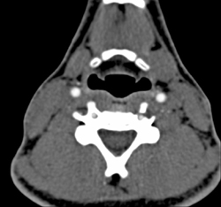 Normal Carotid Arteries - CTisus CT Scan