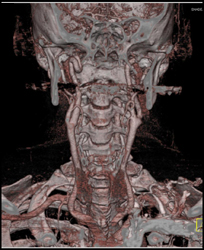 Artifact From Metal Across Carotid Arteries - CTisus CT Scan