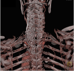 Vascular Map Along the Spine - CTisus CT Scan