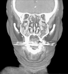 Maxillary Sinuses - CTisus CT Scan