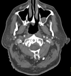 Sinusitis - CTisus CT Scan