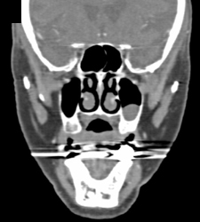 Sinusitis - CTisus CT Scan