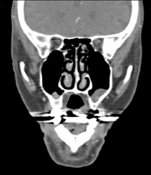 Sinusitis - CTisus CT Scan