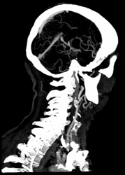 Carotid Stenosis - CTisus CT Scan