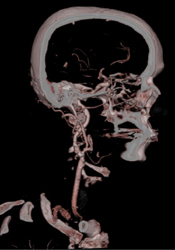 Carotid Stenosis - CTisus CT Scan