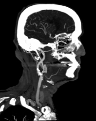 Carotid Stenosis - CTisus CT Scan