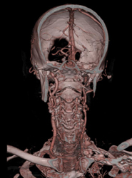 Carotid Stenosis - CTisus CT Scan