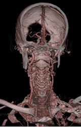 Carotid Stenosis - CTisus CT Scan