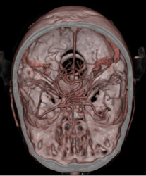 Basilar Artery - CTisus CT Scan