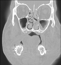 Sinusitis - CTisus CT Scan