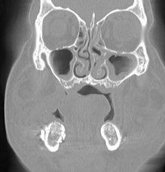 Sinusitis - CTisus CT Scan