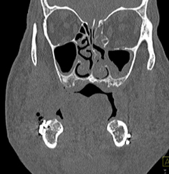 Sinusitis - CTisus CT Scan