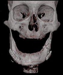 Volume Rendering of the Jaw - CTisus CT Scan