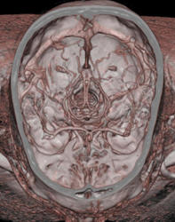 Normal Anatomy - CTisus CT Scan