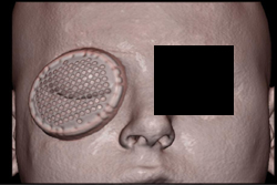 Orbital Trauma - CTisus CT Scan