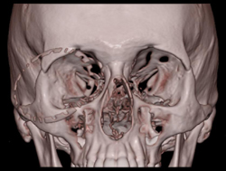 Orbital Trauma - CTisus CT Scan