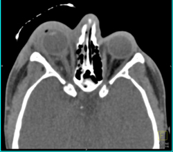 Orbital Trauma - CTisus CT Scan