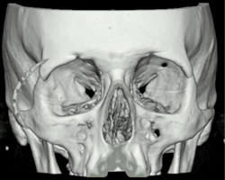 Orbital Trauma - CTisus CT Scan