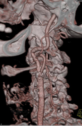 Carotid Stenosis - CTisus CT Scan