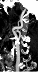 Carotid Stenosis - CTisus CT Scan