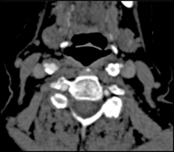 Carotid Stenosis - CTisus CT Scan