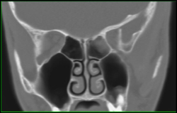 Sinusitis - CTisus CT Scan