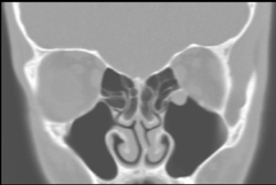 Sinusitis - CTisus CT Scan