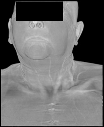 CTA With Volume Rendering Showing Muscle and Vessels - CTisus CT Scan