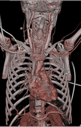 Normal Jugular Veins and Ectatic Carotid Arteries - CTisus CT Scan