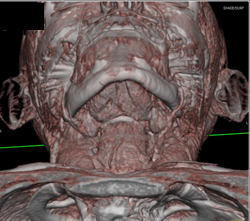 Carotid Bifurcation With Different Renderings - CTisus CT Scan