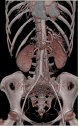 Loeys-Dietz - CTisus CT Scan