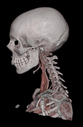 Normal Neck Vessels and Anatomy - CTisus CT Scan