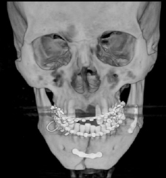 Repair of Mandible Fracture - CTisus CT Scan