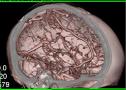 Intracranial Arteriovenous Malformation (AVM) - CTisus CT Scan