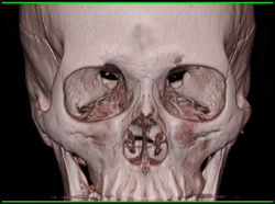 Nice 3D of the Sinuses With Minimal Mucosal Thickening - CTisus CT Scan