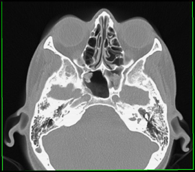 Ethmoid Disease - CTisus CT Scan