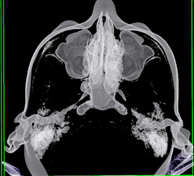 Nice Sinuses and Air Cells - CTisus CT Scan