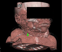 Hemangioma in Left Supraclavicular Zone - CTisus CT Scan