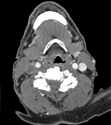 Right Jugular Vein Thrombosis (JVT) - CTisus CT Scan