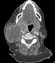 Necrotic Nodes Causes Jugular Vein Thrombosis (JVT) - CTisus CT Scan