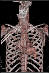 CTA of Neck and Head - CTisus CT Scan