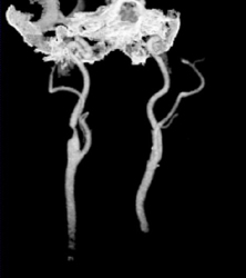 Right Internal Carotid Stenosis With Tracking - CTisus CT Scan