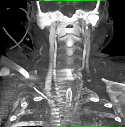 Occluded Jugular Vein Vs Artifact-artifact It Is - CTisus CT Scan