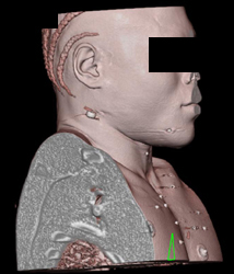 Buckshot Wound to Head Neck and Chest Without Carotid Injury - CTisus CT Scan