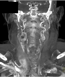 Loeys-Dietz With Ectatic Carotid Artery - CTisus CT Scan