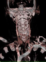 Occluded Left Internal Carotid Artery - CTisus CT Scan